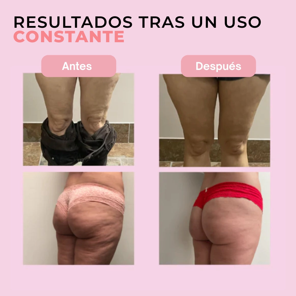 Nuvée | Masajeador Anti-Celulitis para Piernas